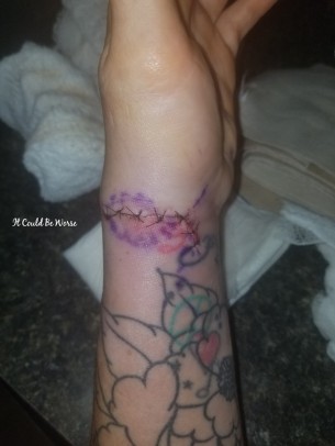 My Ganglion Cyst - The Tetralogy | IT COULD BE WORSE BLOG