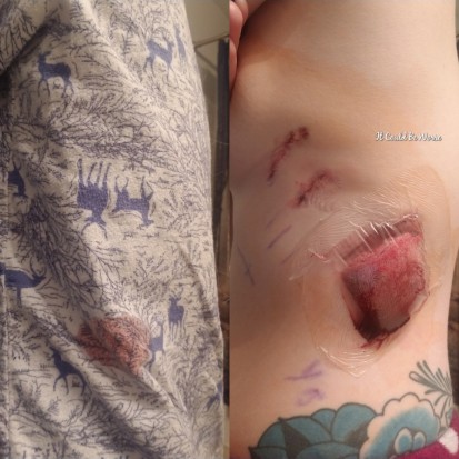 My Wonky Ribs and Neurectomy | IT COULD BE WORSE BLOG