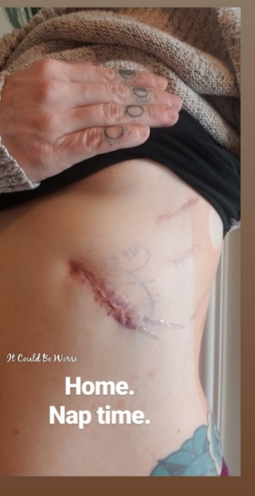 Rib Plating Surgery and Thoracic Appointments | IT COULD BE WORSE BLOG