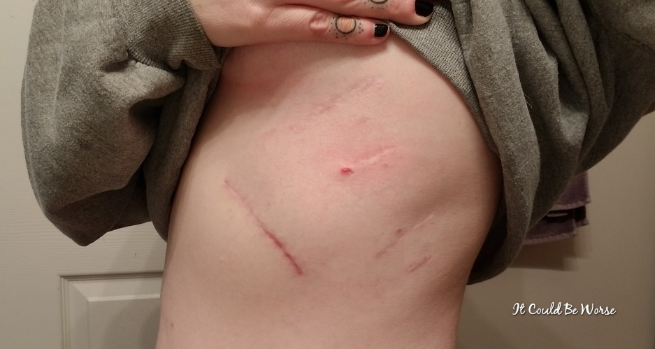 3 Months Post-Op Slipping Rib Syndrome