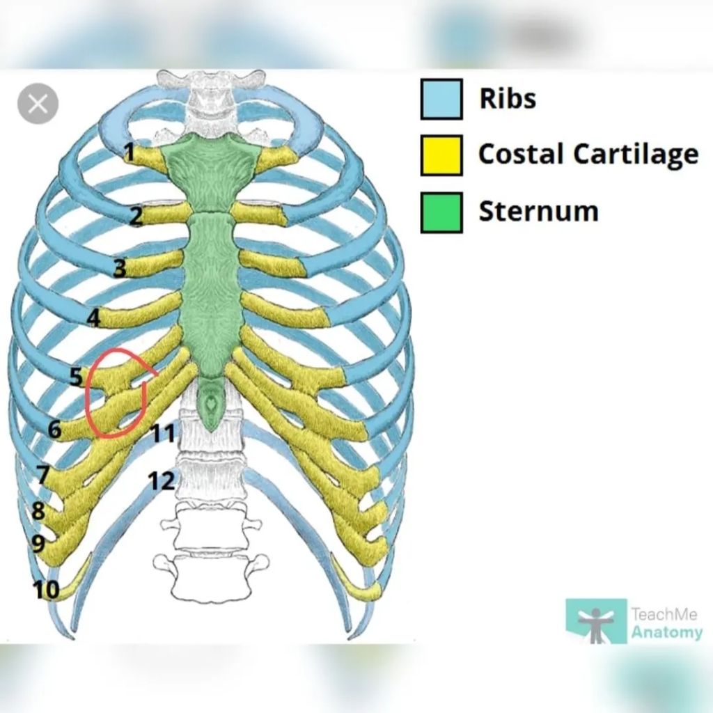 Slipping Rib Syndrome & Bridging Cartilage Fracture